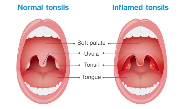 Tonsil Removal