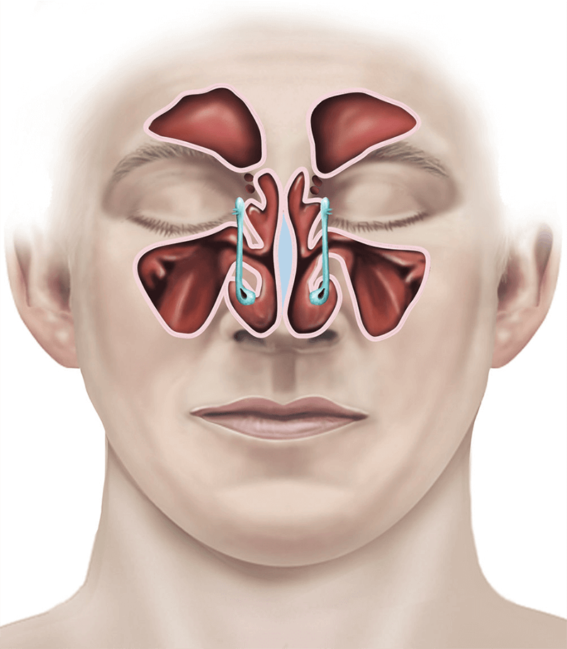 Sinus Surgery